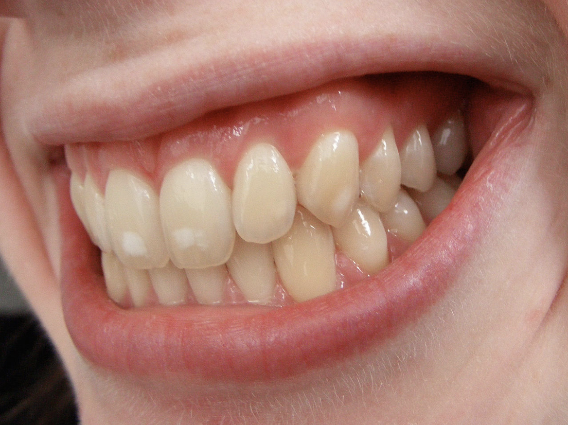 How to Get Rid of Chalky White Spots on Teeth